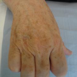 Example of pigmentation